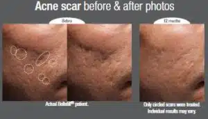 Bellafill acne before and after 1 300x171 1.jpg