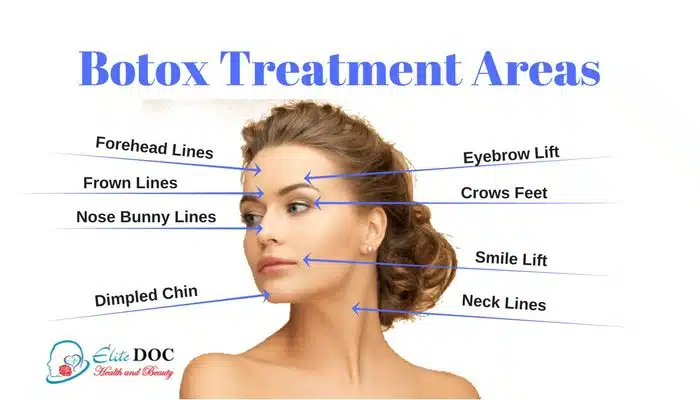 Botox Treatment areas.jpg