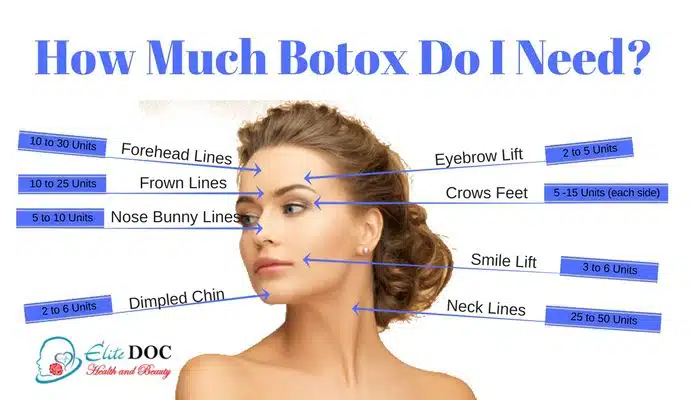 How Much Botox Do I Need.jpg