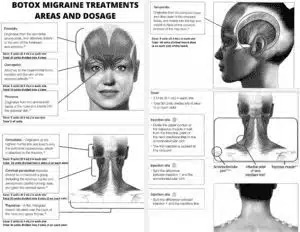 botox migraine treatments 2 300x232 1.jpg