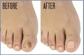 nail fungus before after laser treatment.jpg