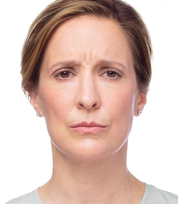 Frown before Dysport treatment