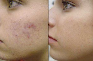 acne laser treatments 1