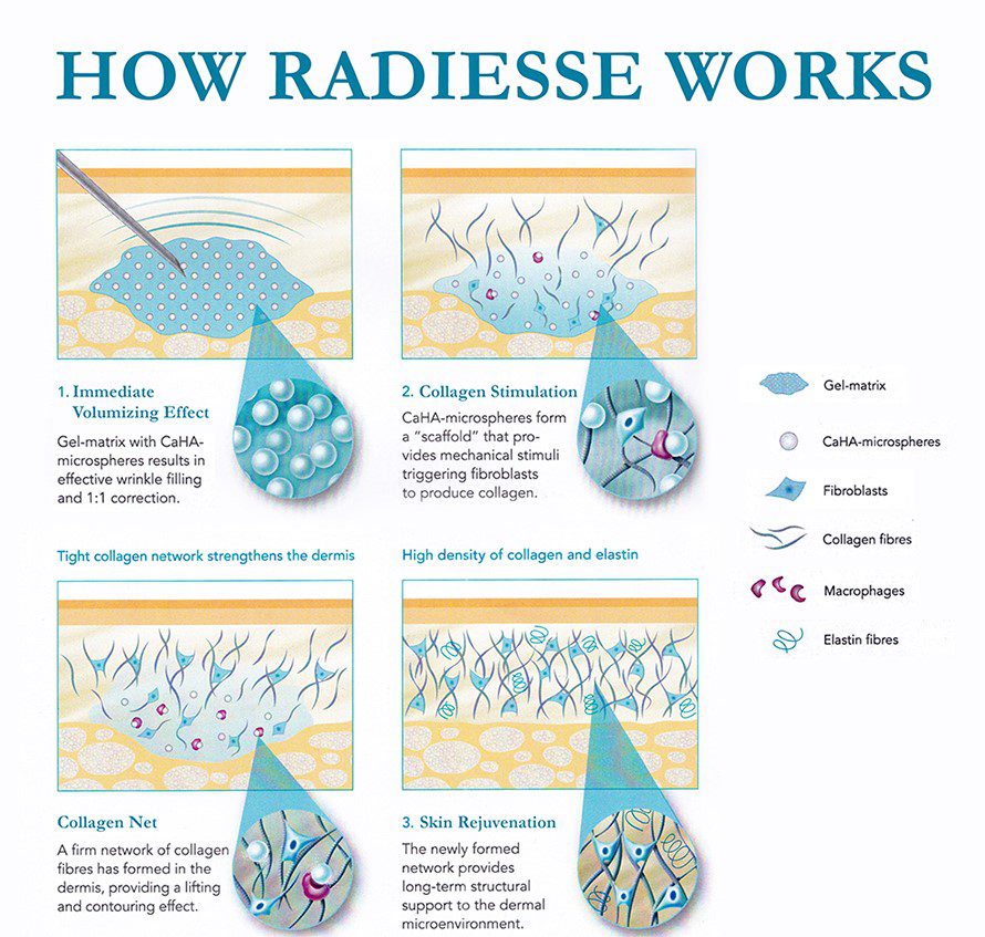how radiesse works