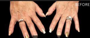 Before Image: Hands Treatment with Bellafill