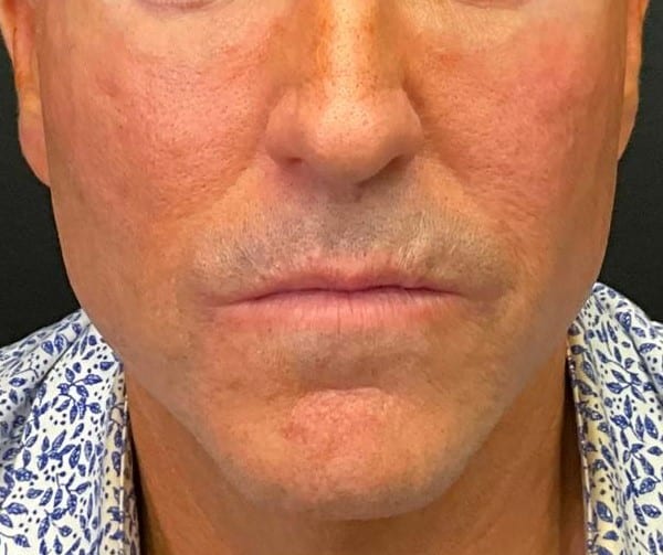 Before Image: Bellafill smile lines and cheek area treatment - left-side