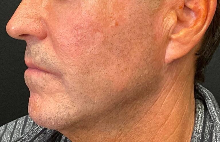 After Image: Bellafill smile lines and cheek area treatment - left-side